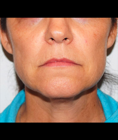 Body Contouring Before and After 02