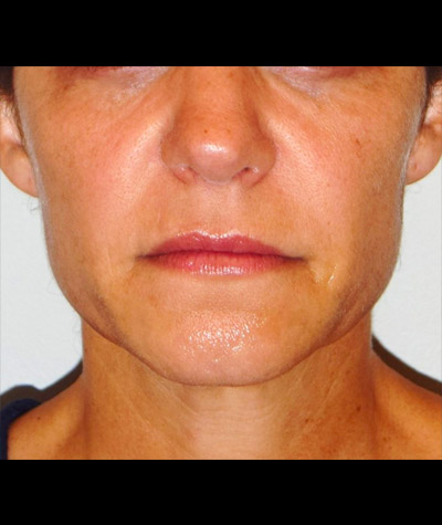 Body Contouring Before and After 09