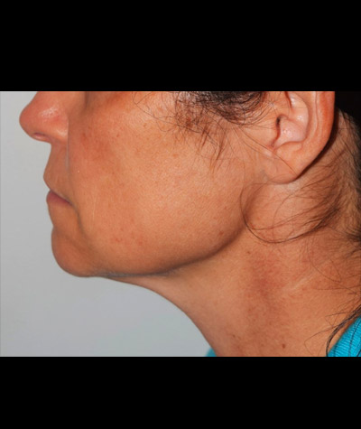 Body Contouring Before and After 02