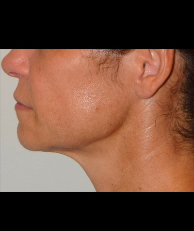 Body Contouring Before and After 02