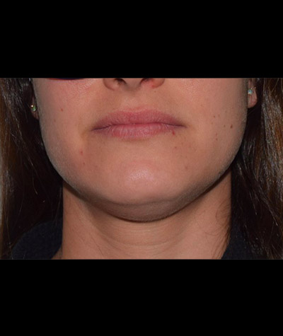 Body Contouring Before and After 03