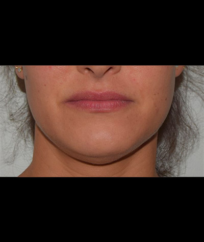 Body Contouring Before and After 09