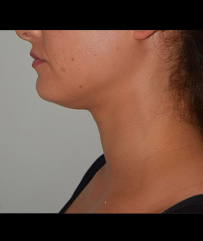 Body Contouring Before and After 03