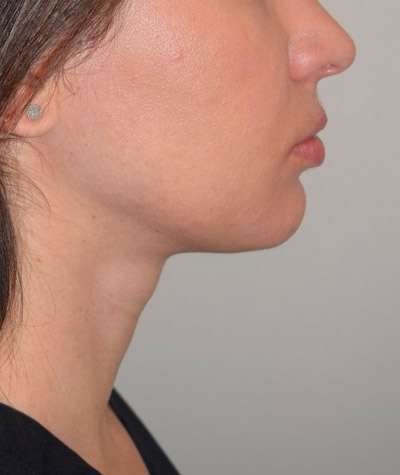 Body Contouring Before and After 04