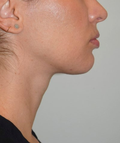 Body Contouring Before and After 09