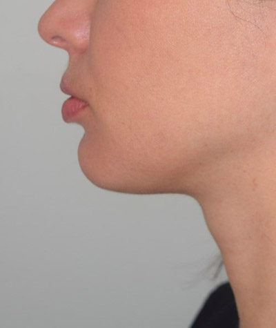 Body Contouring Before and After 04