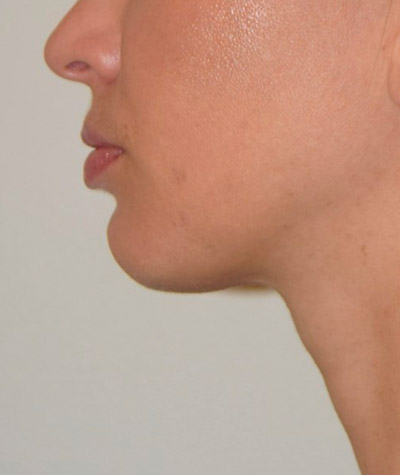 Body Contouring Before and After 04