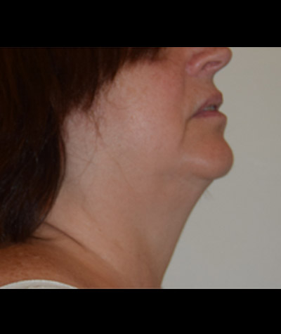Body Contouring Before and After 05
