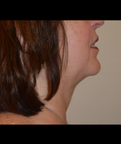 Body Contouring Before and After 09