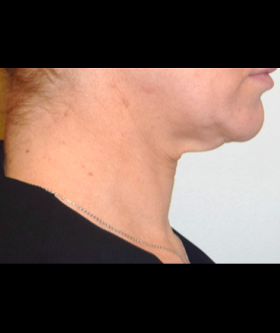 Body Contouring Before and After 06