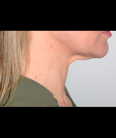 Body Contouring Before and After 09