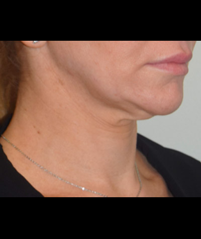 Body Contouring Before and After 06