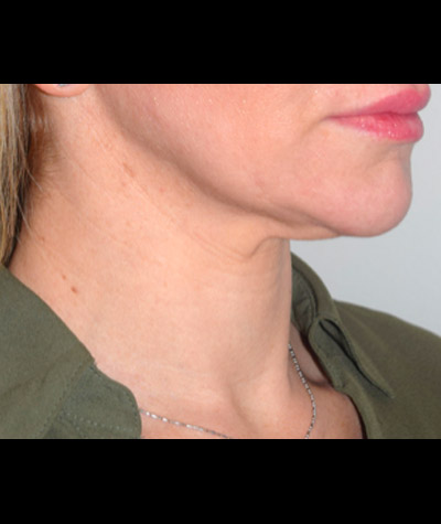 Body Contouring Before and After 06