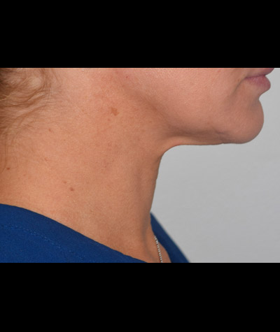 Body Contouring Before and After 06