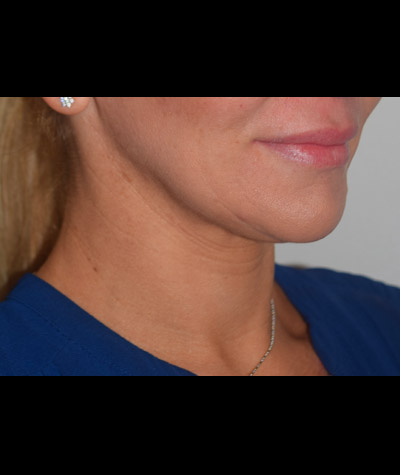 Body Contouring Before and After 06