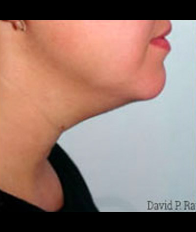 Body Contouring Before and After 07