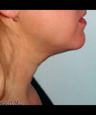 Body Contouring Before and After 09