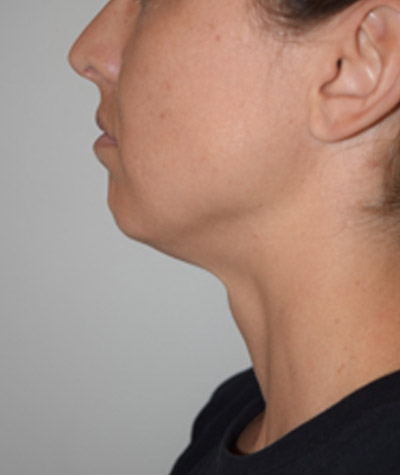 Body Contouring Before and After 09