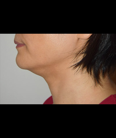 Body Contouring Before and After 10