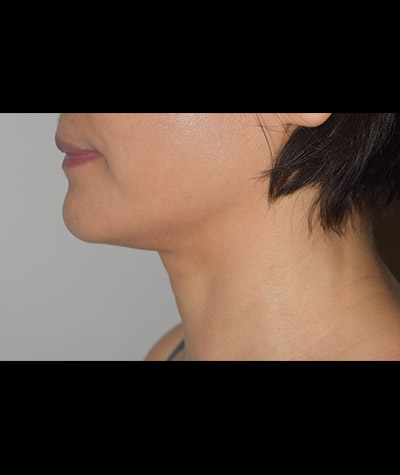 Body Contouring Before and After 09