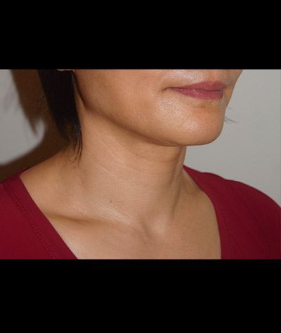 Body Contouring Before and After 10