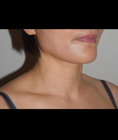 Body Contouring Before and After 10