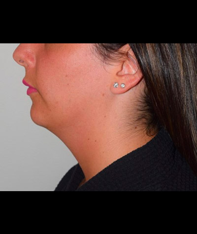 Body Contouring Before and After 11