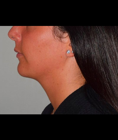 Body Contouring Before and After 09