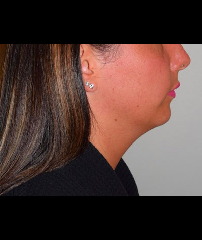 Body Contouring Before and After 11