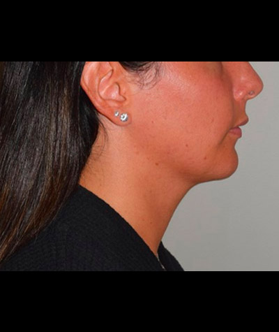 Body Contouring Before and After 11