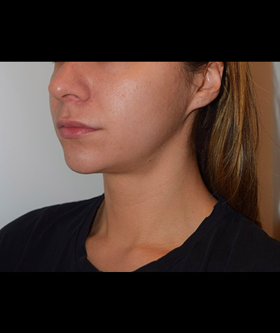 Body Contouring Before and After 12