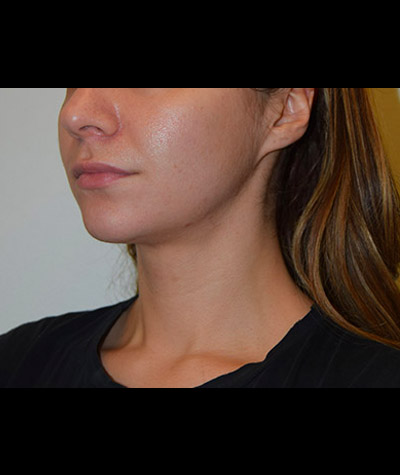 Body Contouring Before and After 09