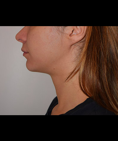 Body Contouring Before and After 12
