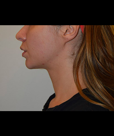 Body Contouring Before and After 12