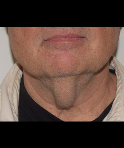 Body Contouring Before and After 13