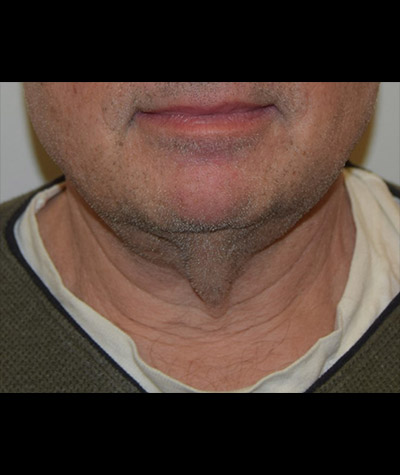 Body Contouring Before and After 09