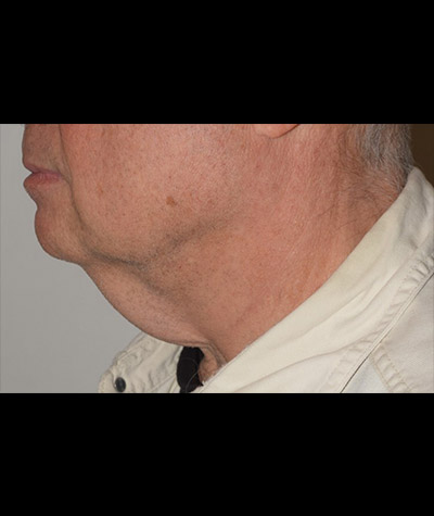 Body Contouring Before and After 13