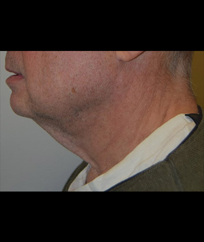 Body Contouring Before and After 13