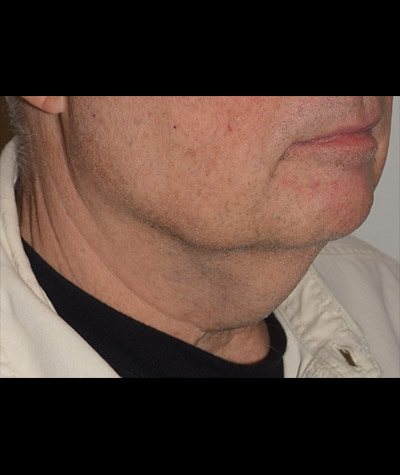 Body Contouring Before and After 13