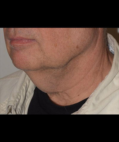 Body Contouring Before and After 13