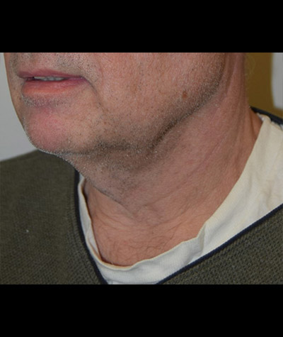Body Contouring Before and After 13