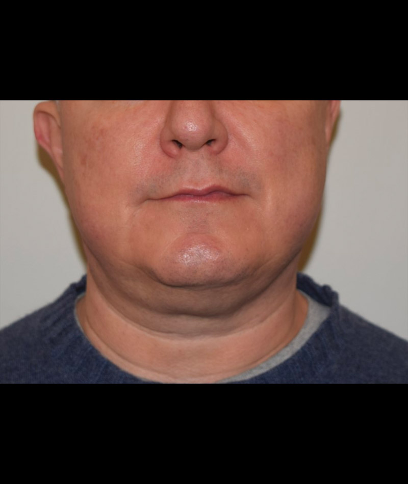 Body Contouring Before and After 14