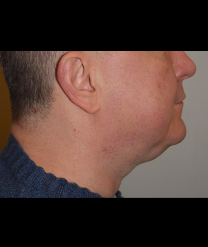 Body Contouring Before and After 14