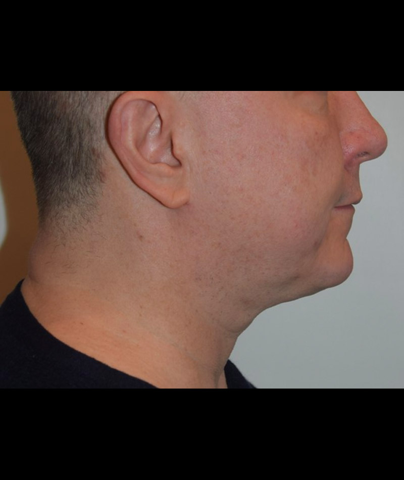 Body Contouring Before and After 14