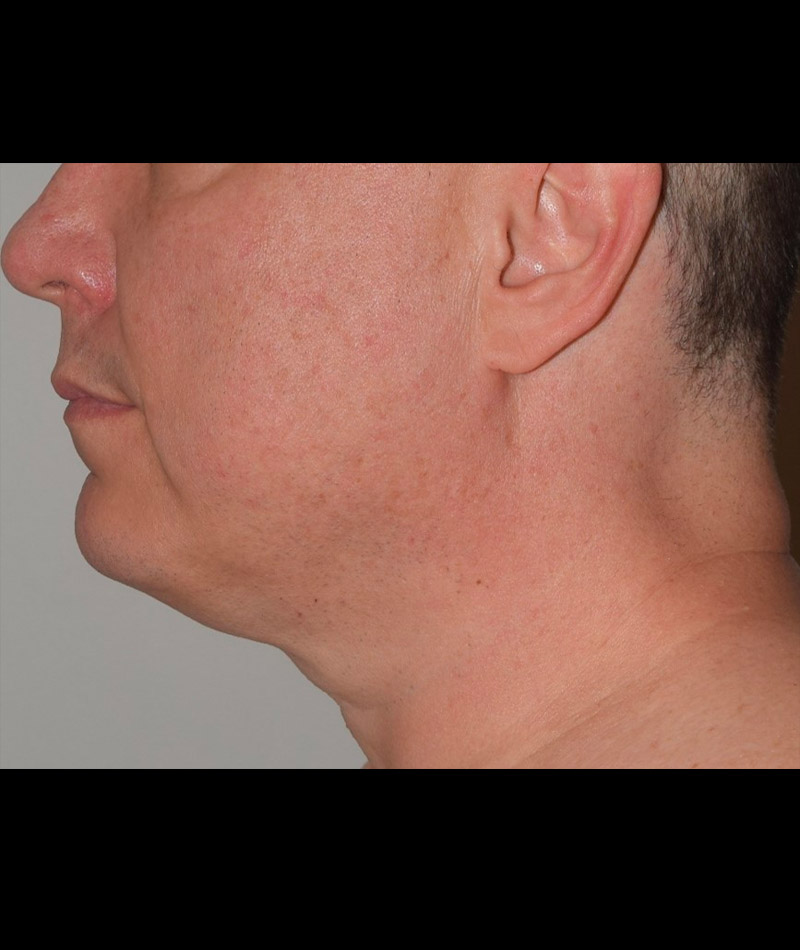 Body Contouring Before and After 14