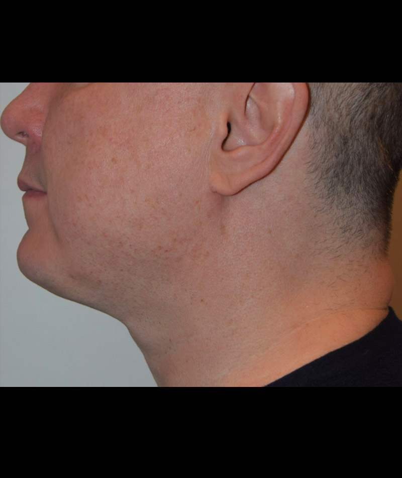 Body Contouring Before and After 14
