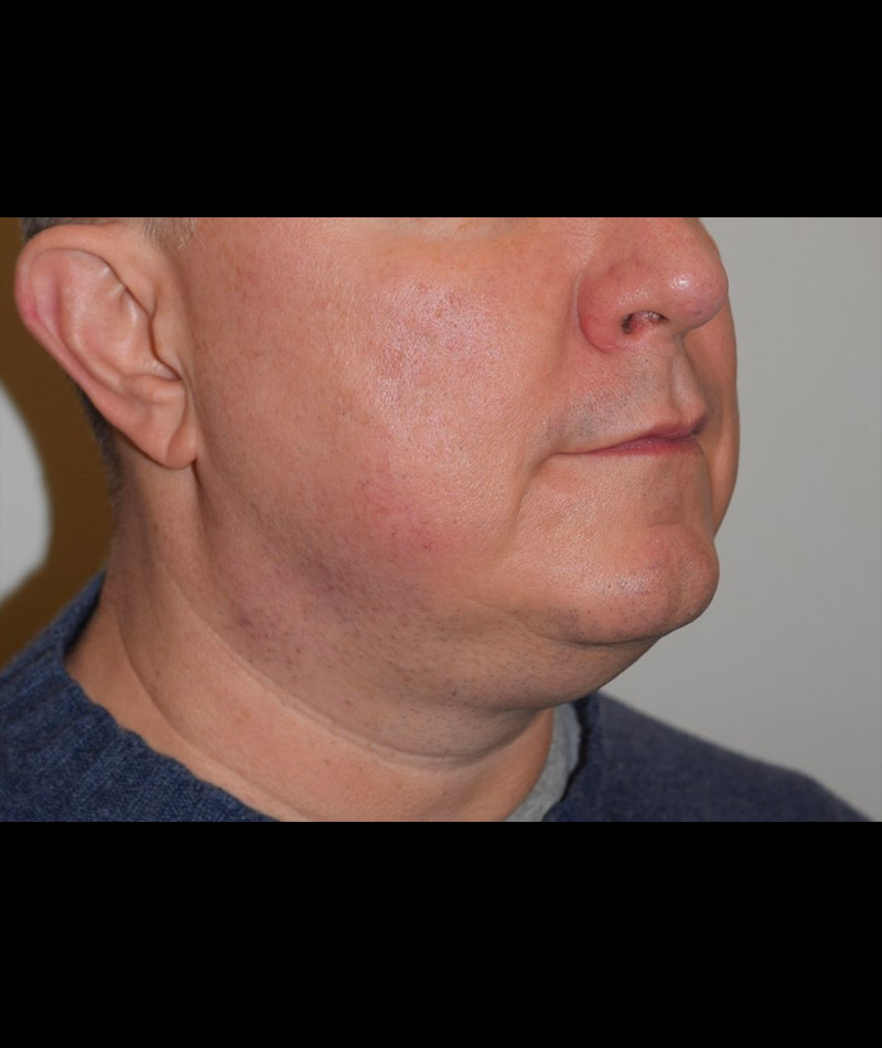 Body Contouring Before and After 14