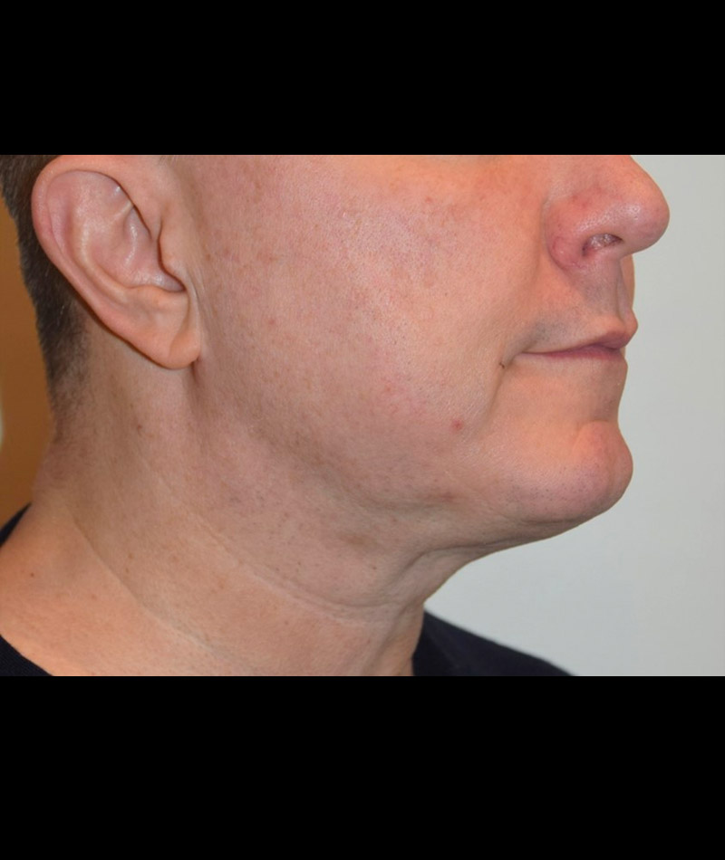 Body Contouring Before and After 14