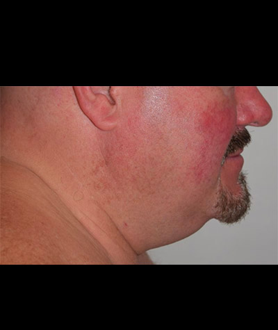Body Contouring Before and After 15