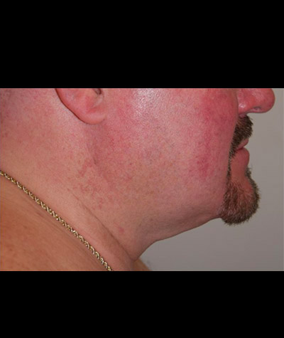 Body Contouring Before and After 09